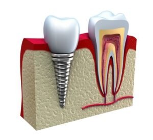 implante dentario