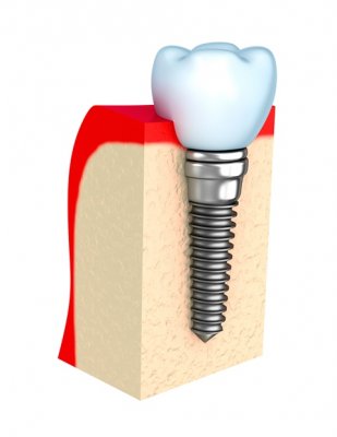 Implante dentario exagono externo