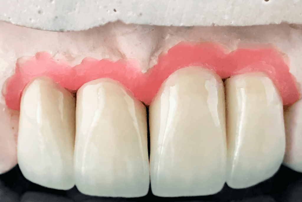 Colocar prótese dentária dói? Entenda o que avaliar antes de colocar Palavra-chave: colocar prótese dentária dói