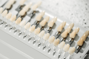 Prótese sobre Implante: Entenda como é Feito e Porque Escolher Essa Opção