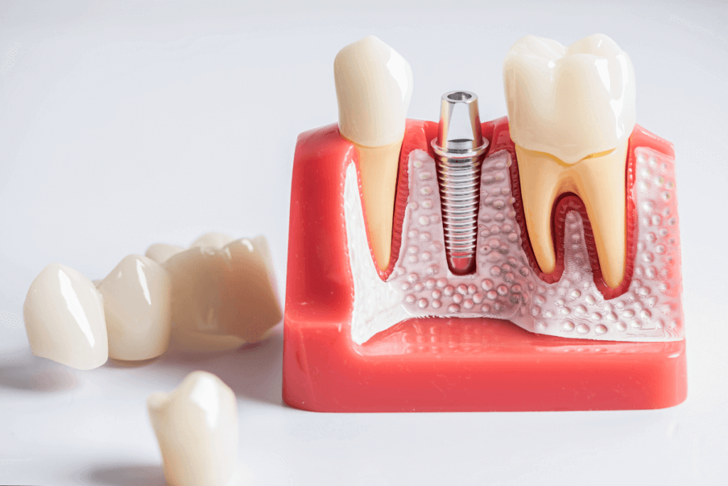 Implantes de Dentes: Transformando Sorrisos com a Precisão da Odontologia Moderna